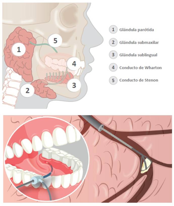 2019 11 15 La sialoadenitis obstructiva crónica es la inflamación recurrente de las glándulas salivales
