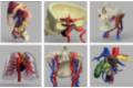 2021 05 26 Varios ejemplos de modelos quirúrgicos personalizados en 3D